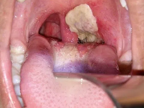 7 nhóm người có nguy cơ cao mắc bệnh bạch hầu