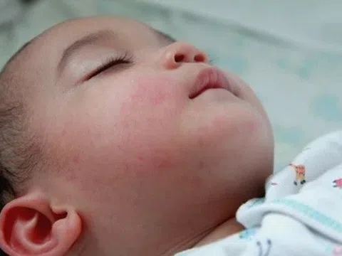 Biểu hiện trẻ sơ sinh mắc sốt xuất huyết chuyển nặng