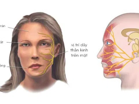 Thời tiết miền Bắc chuyển lạnh, coi chừng liệt dây thần kinh số 7