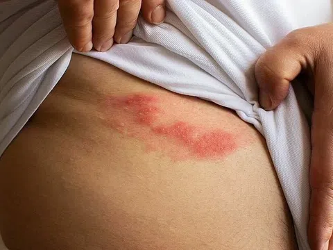 Căn bệnh 'đau hơn đau đẻ', có thể mắc nhiều lần trong đời