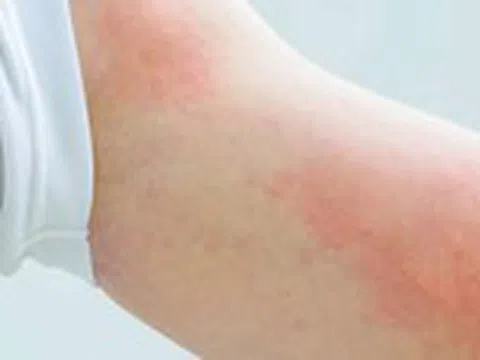 Ám ảnh dị ứng thời tiết lúc giao mùa, xử trí thế nào?