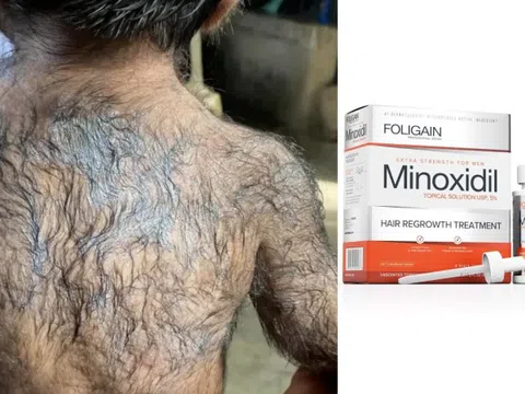 Bố sử dụng thuốc mọc tóc, trẻ sơ sinh biến thành 'người sói'