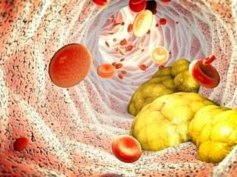 Cách ăn uống để giảm mỡ máu
