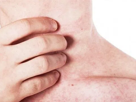Không chỉ trẻ em, người lớn mắc sởi cũng dễ biến chứng nguy hiểm chớ chủ quan