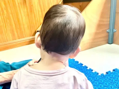 Bé 4 tháng tuổi bị vẹo cổ vì gia đình cho làm việc này quá sớm