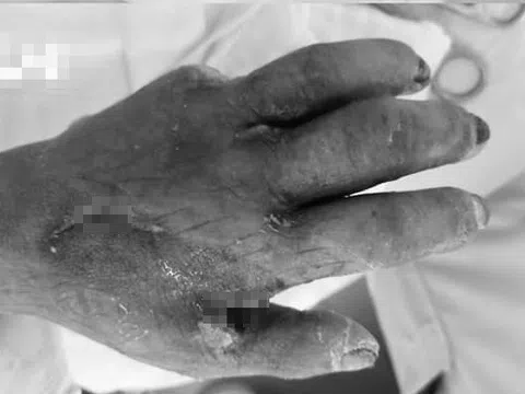 Suýt mất bàn tay chỉ vì một vết ngứa nhỏ