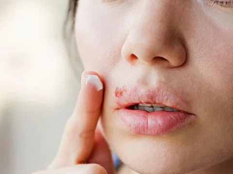 Dấu hiệu bạn đã nhiễm Herpes sinh dục