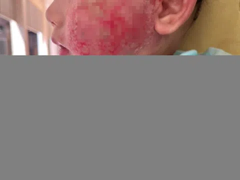 Tắm lá sai cách, em bé phải chịu hậu quả không đáng có