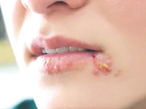 Những điều ít ai nói về bệnh lậu