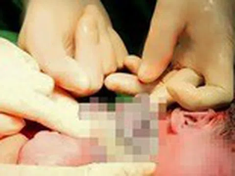 Bé gái chào đời với 9 vòng dây rốn quấn cổ
