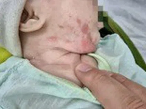 Bé 2 tháng tuổi mắc giang mai lây từ mẹ, bác sĩ nói phòng tránh được