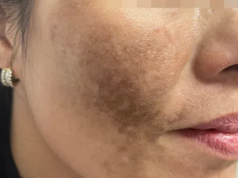 Trị nám cấp tốc đón Tết, người phụ nữ bỏng sạm da mặt