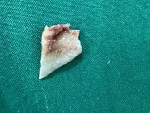 Bé gái phải cấp cứu nội soi vì sự cố khi ăn cháo