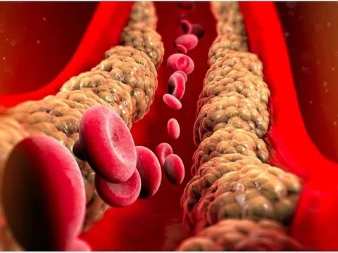 Viêm tuỵ cấp do mỡ máu tăng cao ở người trẻ, làm gì để phòng bệnh