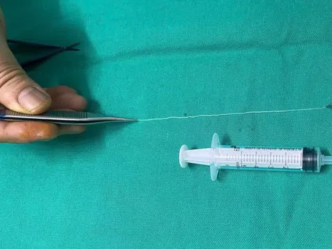 Phẫu thuật gắp con giun dài 14cm trong mắt bệnh nhân