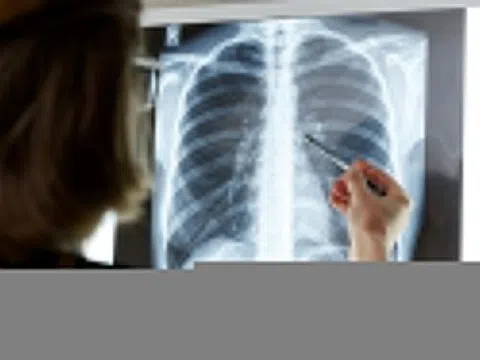 Một dạng viêm phổi biến chứng nguy hiểm khó lường