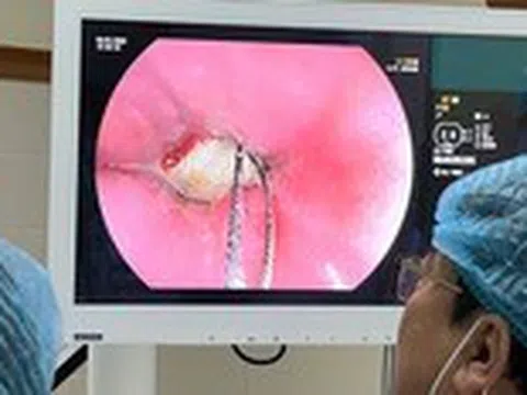 Cứu sống nam thanh niên nhập viện vì bị hóc xương heo