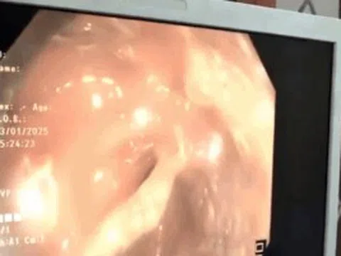 Nhập viện vì đại tiện ra máu, người phụ nữ bất ngờ khi biết lý do