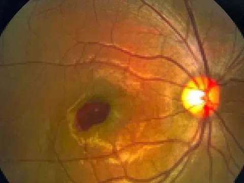 Nam thanh niên suýt mù vì đèn laser chiếu thẳng vào mắt 2 giây