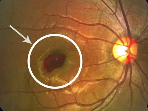 Bệnh nhân bị cháy hoàng điểm mắt do đèn laser sân khấu đã xuất viện