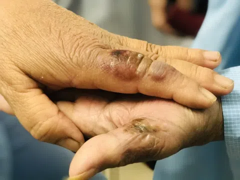 Hai vợ chồng nhập viện vì chủ quan khi đuổi bắt chuột
