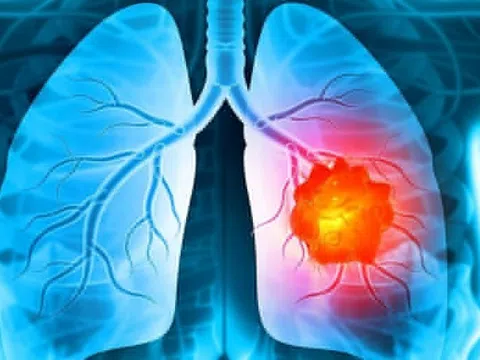Các dấu hiệu cảnh báo ung thư phổi cần lưu ý