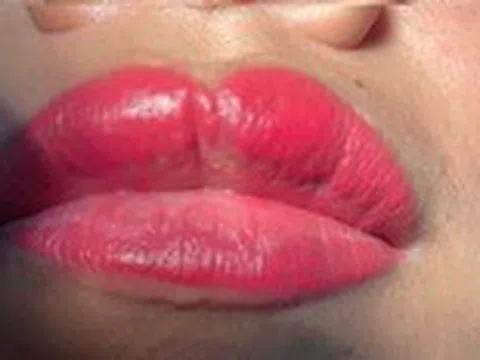 Xăm môi đón Tết, cô gái hốt hoảng tìm bác sĩ vì thành ‘môi cá trê’