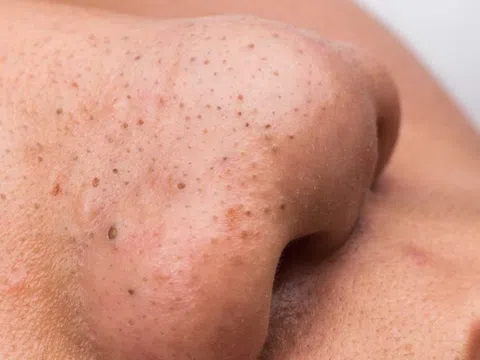 Cách trị mụn đầu đen trên mặt hiệu quả