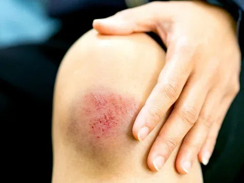 Cách xử lý vết thương phần mềm do va đập