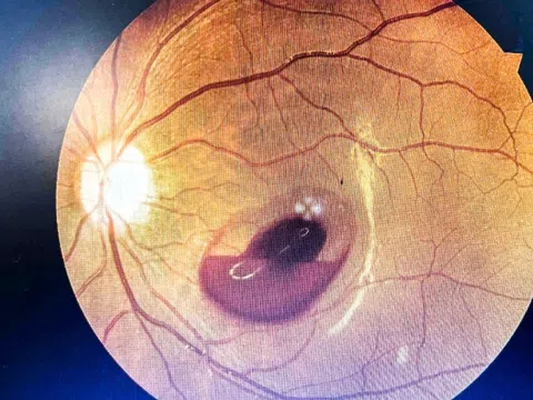 Đi bar chơi, cô gái 18 tuổi mất thị lực do bị tia laser chiếu vào mắt