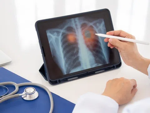 Nguyên nhân bất ngờ khiến nhiều người mắc bệnh COPD
