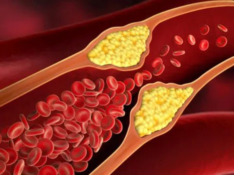 Khả năng điều trị dứt điểm mỡ trong máu
