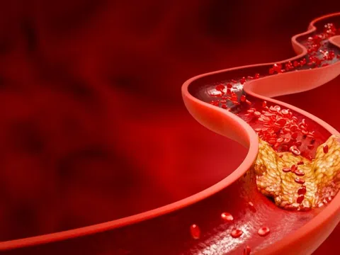 Cách giảm mỡ máu không cần dùng thuốc