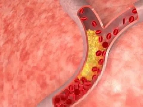 Người bệnh rối loạn mỡ máu nên ăn gì?