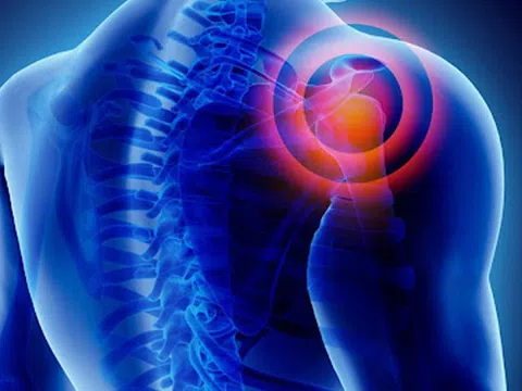 Đau vai bất thường, cẩn trọng viêm khớp vai