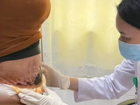 Nám đen, hoại tử da sau phẫu thuật hút mỡ bụng tại spa