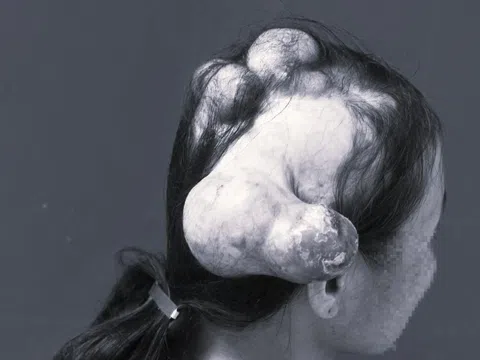 Bệnh ung thư khiến người phụ nữ 'mọc sừng' chi chít trên đầu