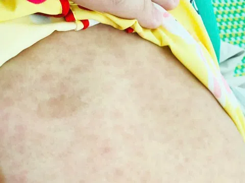 Hàng loạt ca sốt phát ban ở xã miền núi Quảng Nam dịp Tết, 2 trẻ chết do tiêu chảy