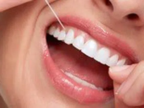 Dùng chỉ nha khoa thường xuyên có thể giảm nguy cơ đột quỵ?