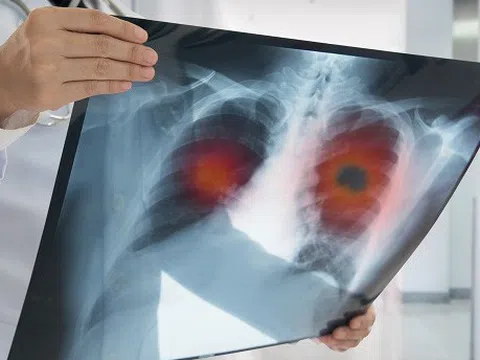 Nghiên cứu mới chỉ ra 5 'sát thủ ung thư' nguy hiểm nhất