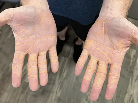 Ăn toàn thịt, người đàn ông bị 'nhuộm vàng' khắp người