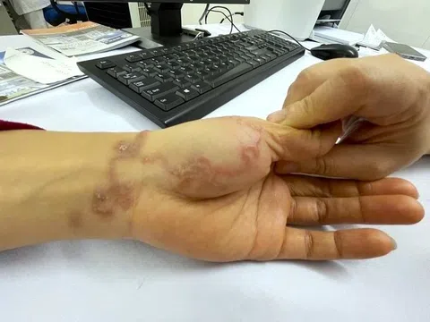 Sán bò lổm ngổm dưới da người phụ nữ nuôi chó