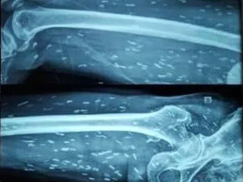 Món khoái khẩu khiến người đàn ông bị sán ký sinh khắp cơ thể