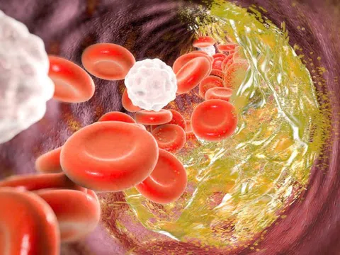 Cách giảm mỡ máu tự nhiên