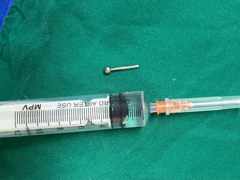 Sự cố bất ngờ từ chiếc khuyên lưỡi khiến cô gái trẻ nhập viện