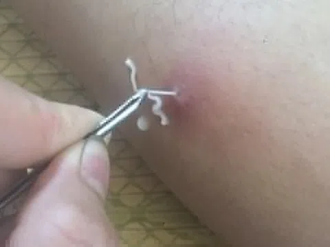 Giun rồng dài hơn 10 cm 'chui' ra từ đầu gối người đàn ông