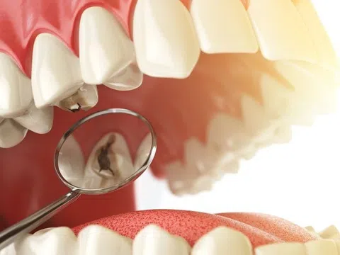 Nhận biết sâu răng giai đoạn sớm
