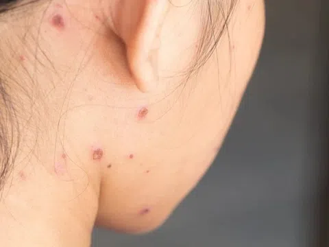 Ba giai đoạn phát ban của bệnh thủy đậu