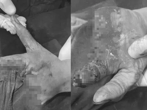 Người phụ nữ đi cấp cứu với bàn tay dập nát