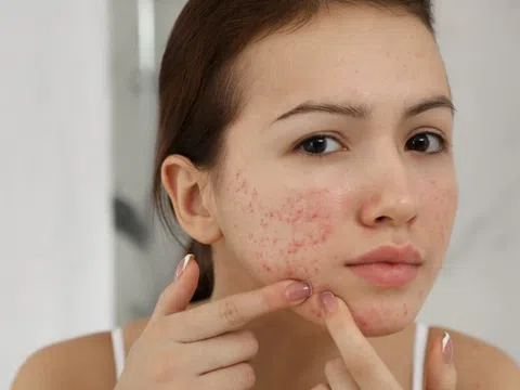 4 thay đổi nhỏ giúp ngăn ngừa mụn trứng cá